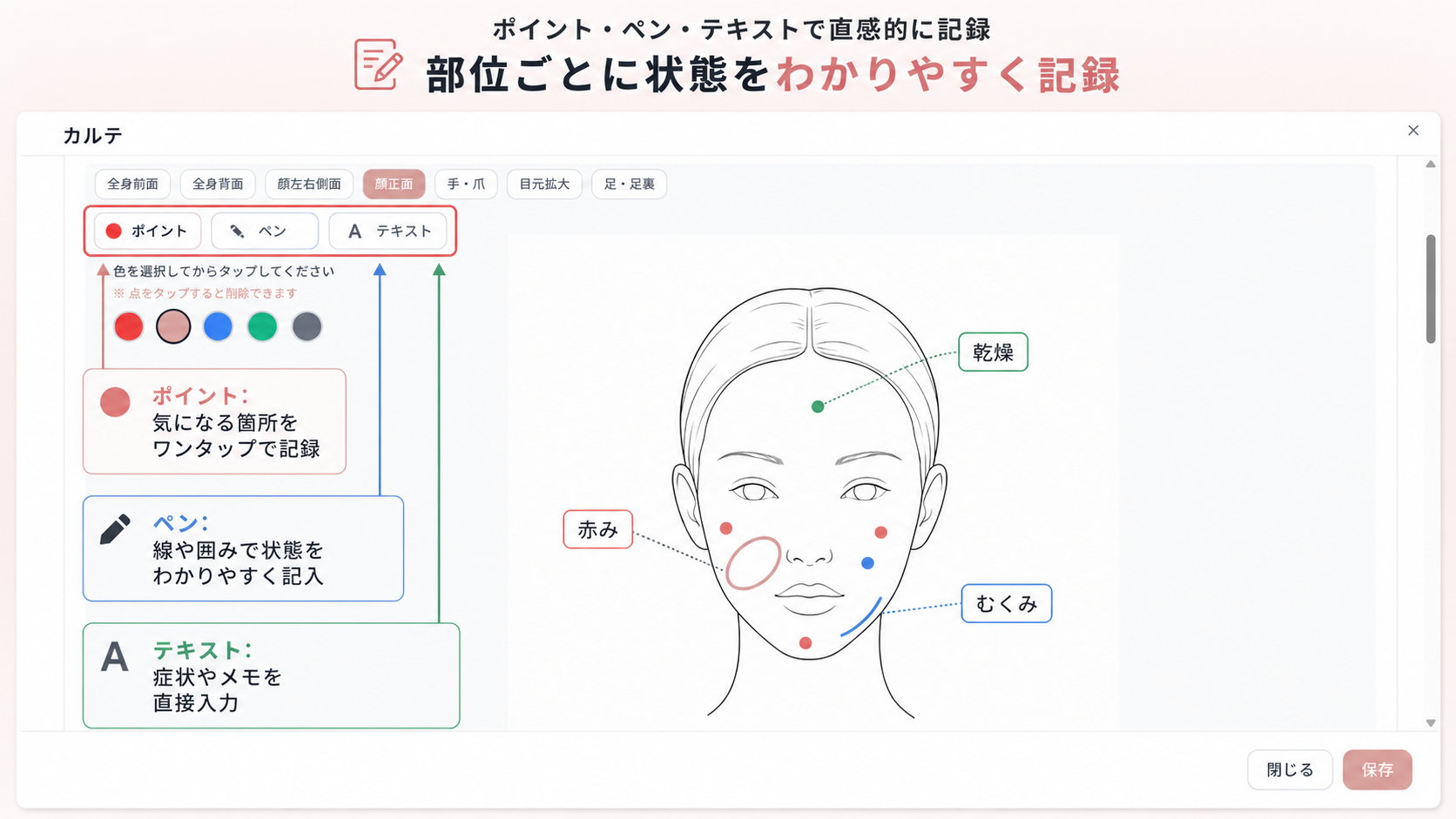 カルテの部位図に、ポイント(気になる箇所をワンタップ)・ペン(線や囲みで状態を記入)・テキスト(症状やメモを直接入力)で記録している画面